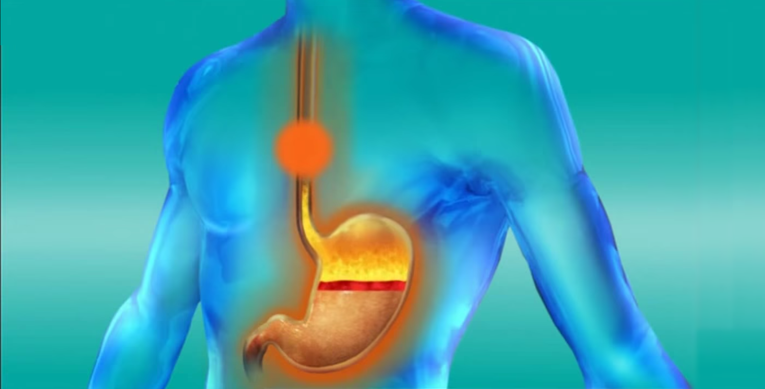 regular-heartburn-could-be-stomach-cancer-sufferers-urged-to-see